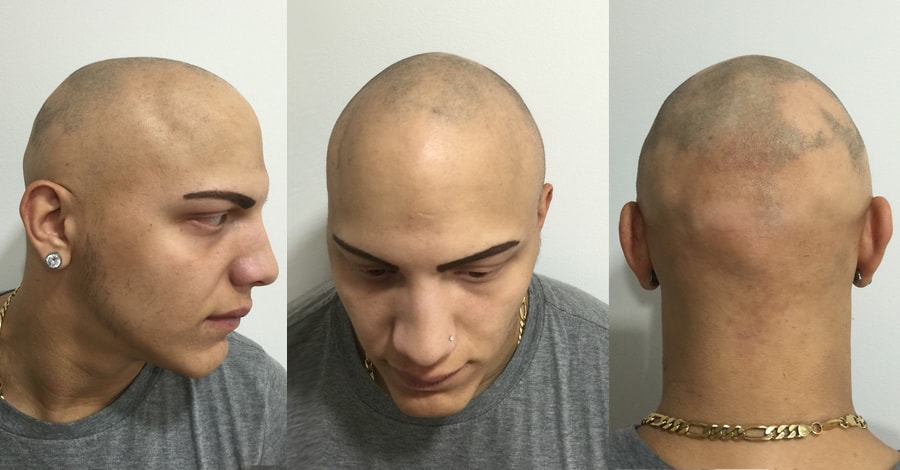 7 Rimedi Naturali Per l'Alopecia Androgenetica | Alopecia24