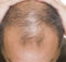Alopecia Medicina Rigenerativa